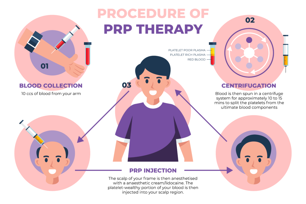 PRP Injections procedure